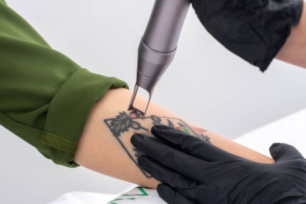 Tattoo Removal2.jpg